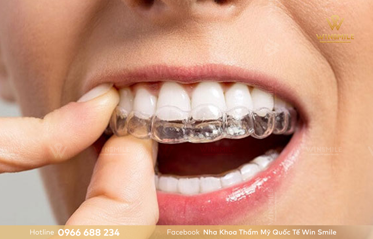 Niềng răng Invisalign hàm trên có mức chi phí cao nhất.