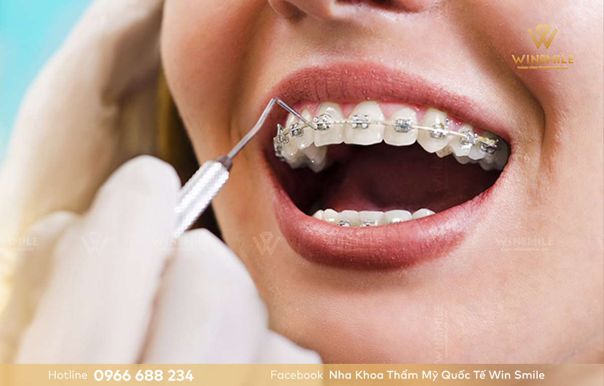 Niềng răng hàm trên được áp dụng nhằm đưa răng về đúng vị trí mong muốn.