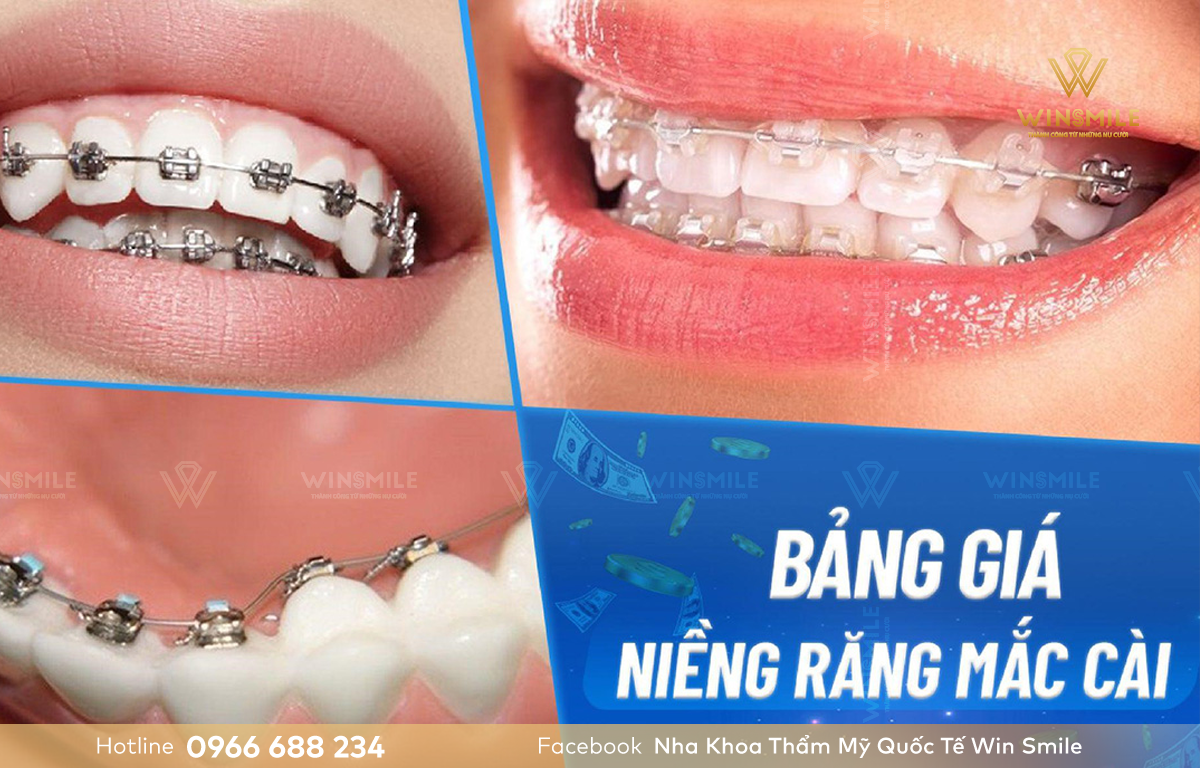 Giá niềng răng mắc cài khá đa dạng tùy thuộc vào loại mắc cài.