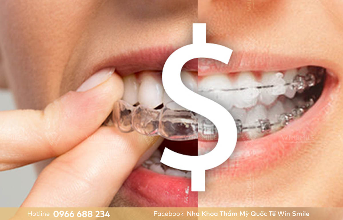 So với phương pháp truyền thống, niềng răng Invisalign giá cao hơn gấp nhiều lần.