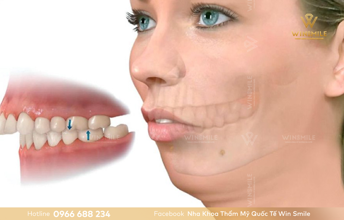 Hô hàm trên khiến răng chìa ra phía trước, trục răng ngả