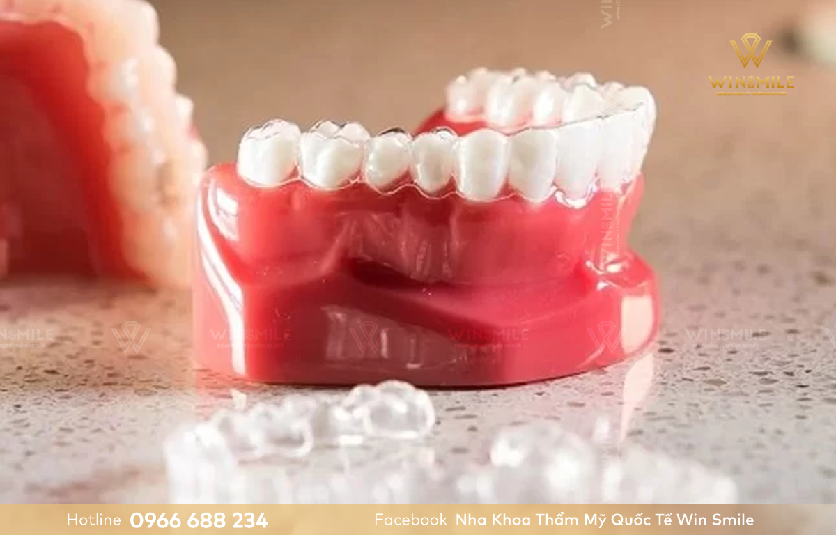 Niềng răng trong suốt được coi là cuộc cách mạng trong ngành chỉnh nha