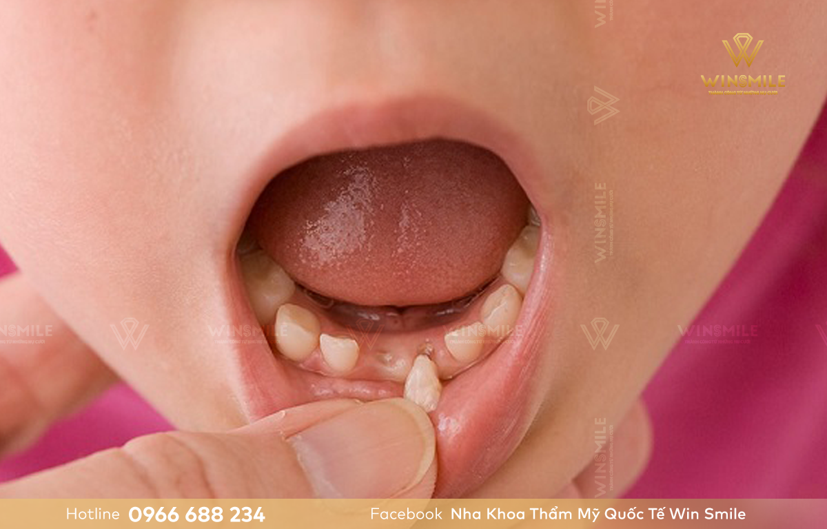 Nhổ răng sữa khi đã có mầm răng vĩnh viễn để tránh răng mọc lệch lạc trên cung hàm
