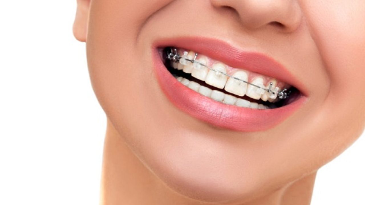 Giá niềng răng móm hàm trên và hàm dưới là giống nhau.