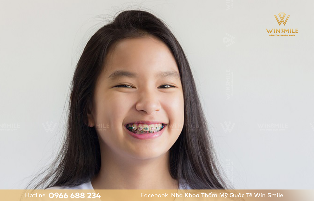 Niềng răng cho trẻ ở giai đoạn từ 12-16 tuổi được đánh giá là thời điểm vàng.