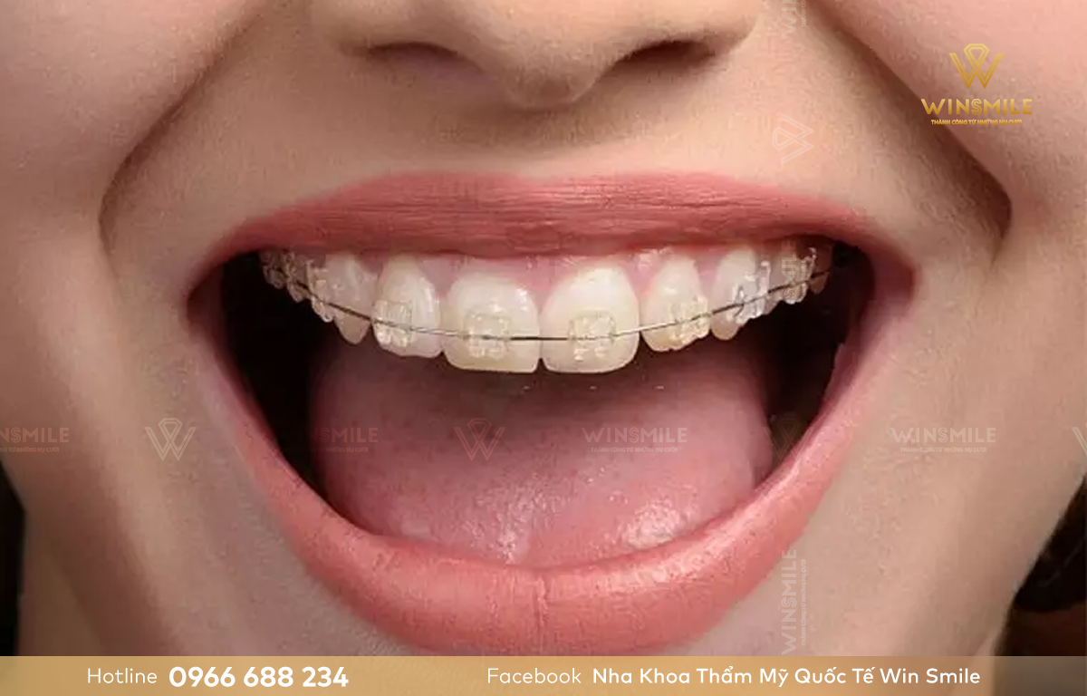Làm răng giả vẫn có thể niềng răng chỉnh nha