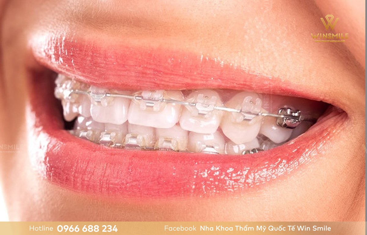 Niềng răng mắc cài sứ dây trong có chi phí cao hơn so với các dòng mắc cài truyền thống.