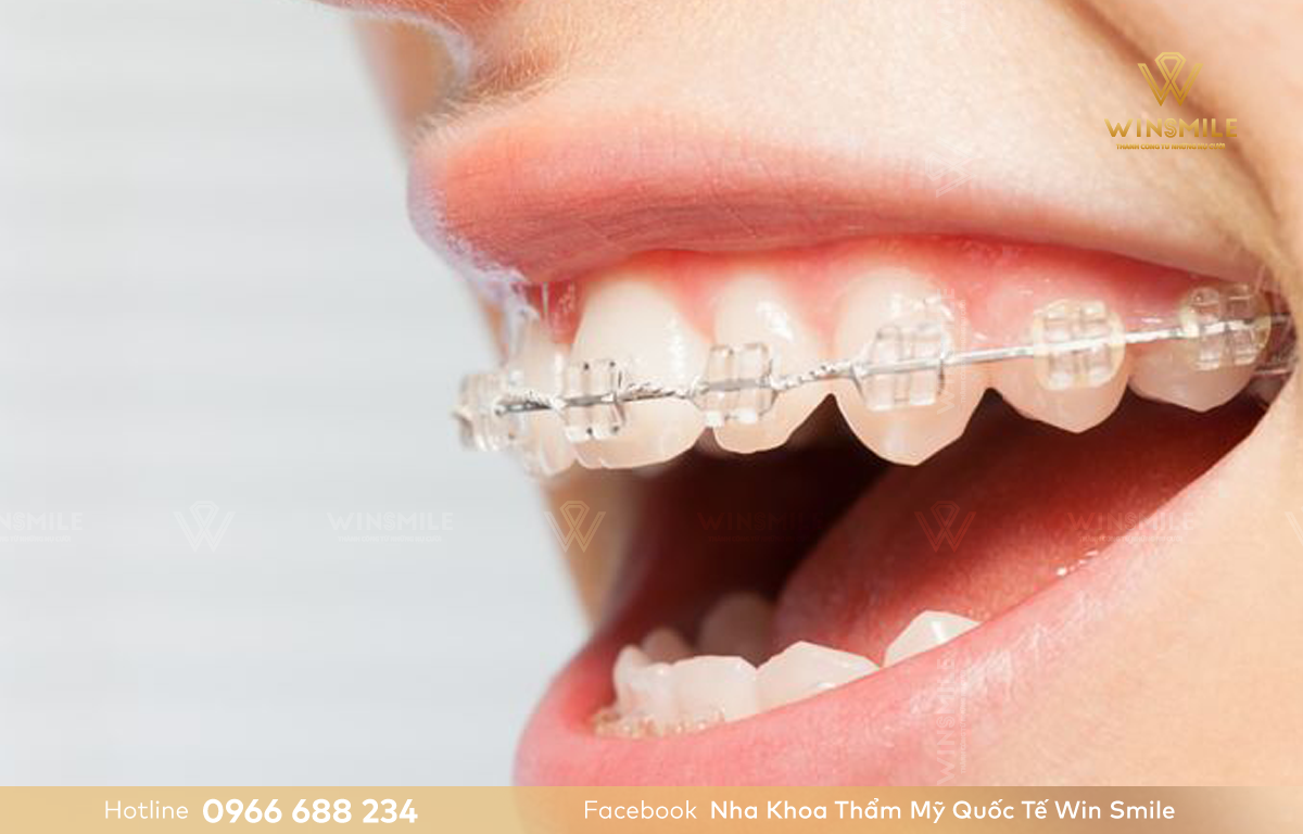 Niềng răng mắc cài là giải pháp hiệu quả giúp đưa răng về đúng vị trí mong muốn