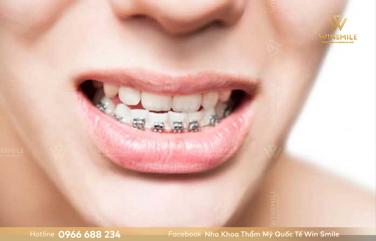 Niềng răng móm bao lâu phụ thuộc vào nhiều yếu tố