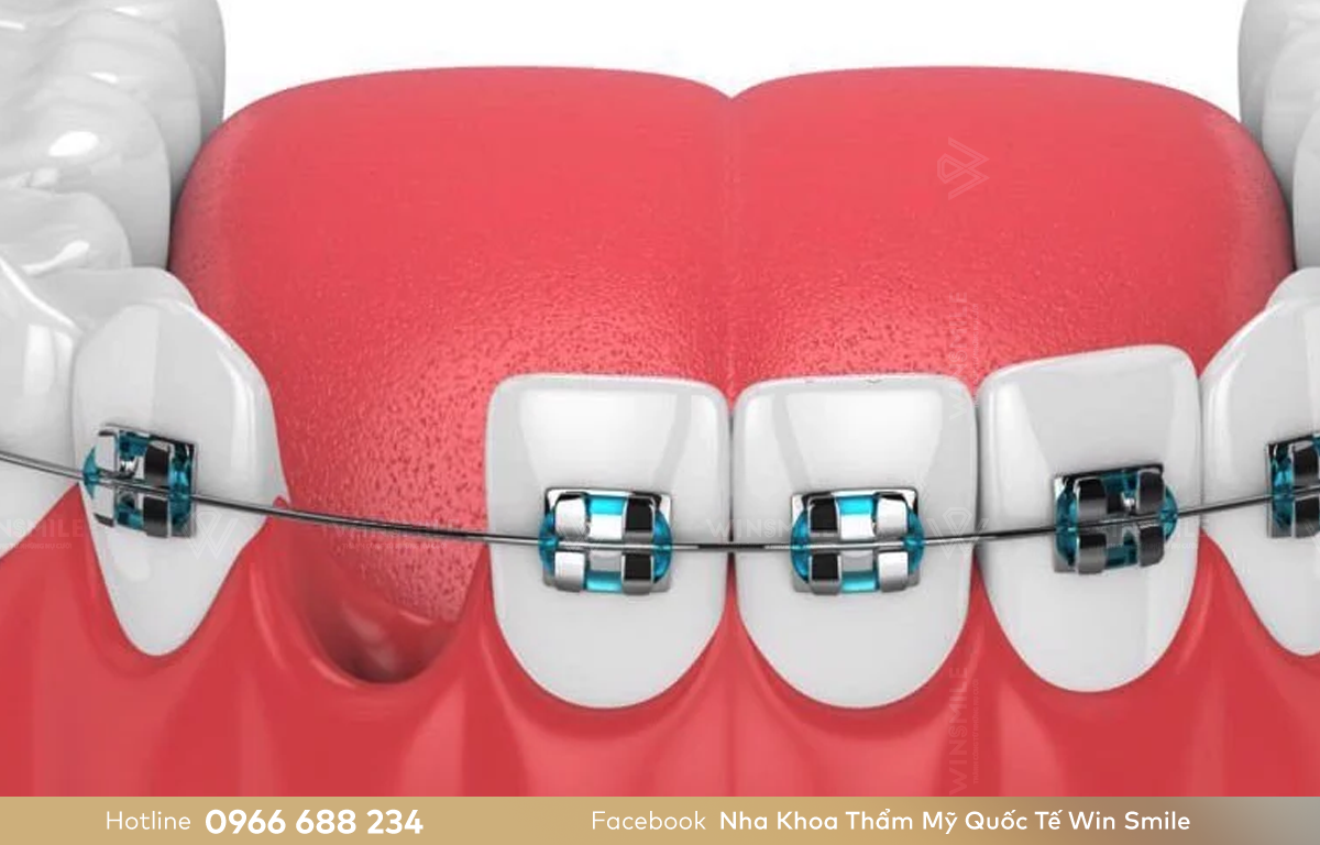 Niềng răng móm có thể phải nhổ răng nếu cấu trúc răng phức tạp