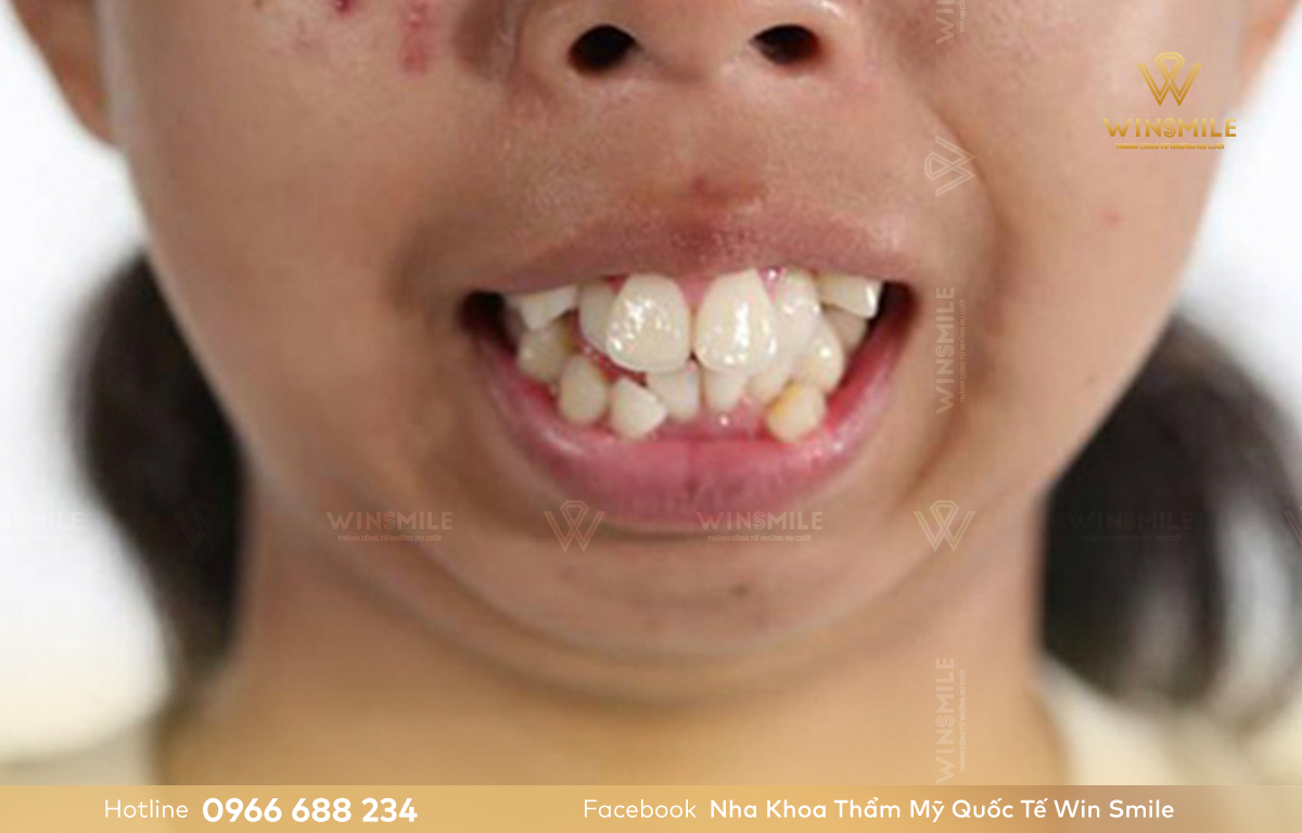 Răng hô ảnh hưởng nhiều đến thẩm mỹ gương mặt