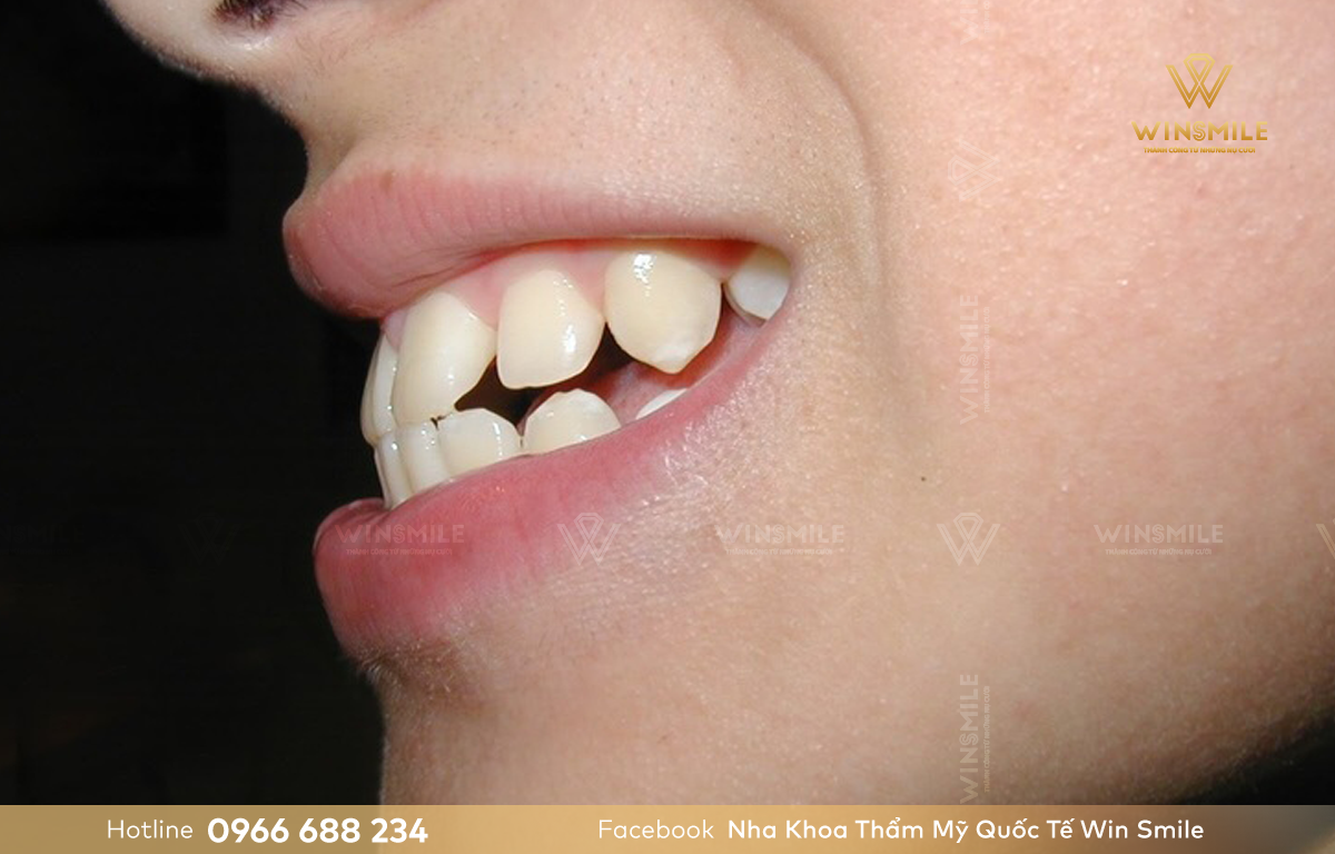 Răng hô là tình trạng hàm trên chìa ra phía trước