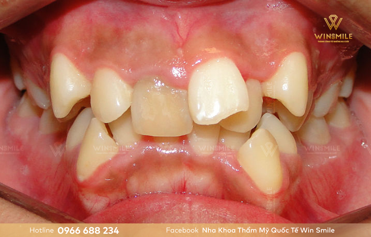 Răng khấp khểnh nặng buộc phải nhổ răng để tạo khoảng trống