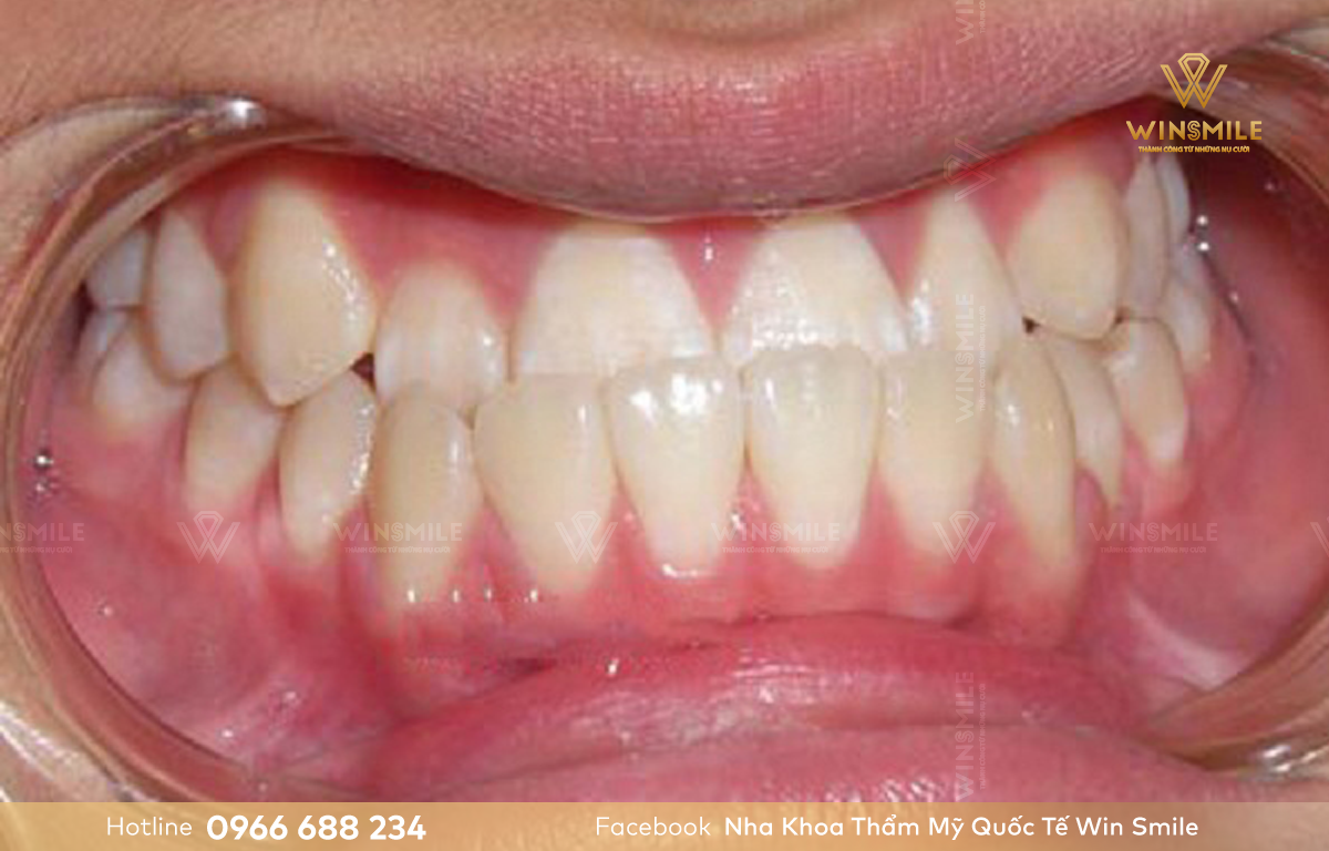 Răng móm là phần hàm dưới bao phủ hàm trên