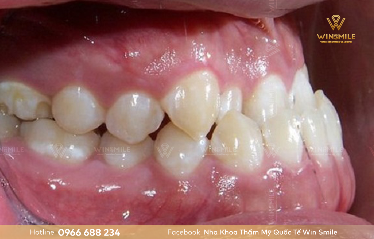 Răng móm có 2 nguyên nhân gây nên là móm do răng hoặc do hàm.