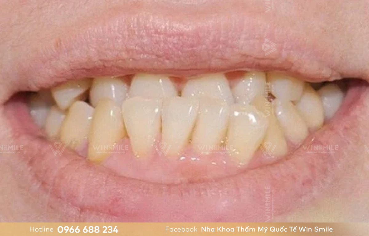 Răng móm kèm chen chúc bắt buộc bác sĩ phải tiến hành nhổ răng