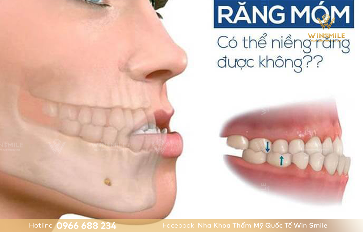 Răng móm có nên niềng răng không phụ thuộc vào nguyên nhân gặp phải