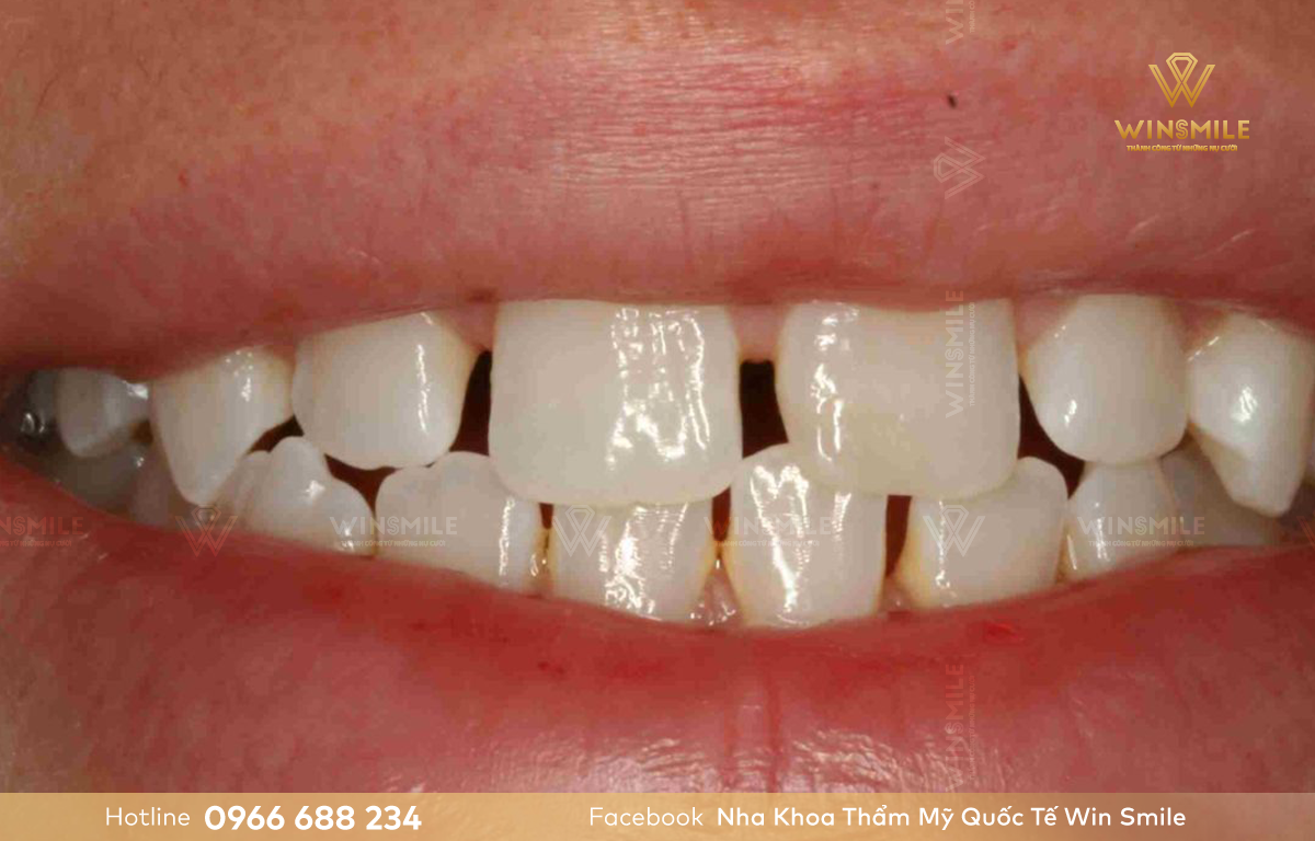 Răng thưa là tình trạng xuất hiện khoảng cách giữa các răng