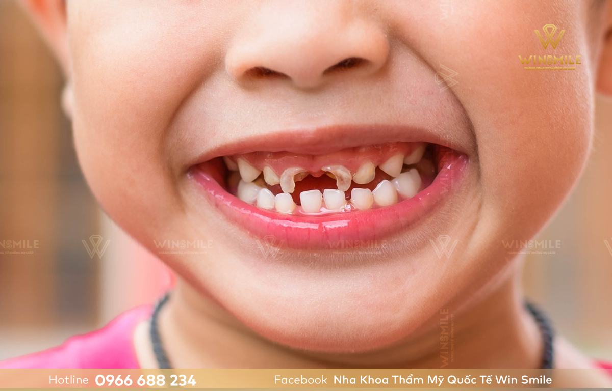 Sâu răng ở trẻ do răng thưa