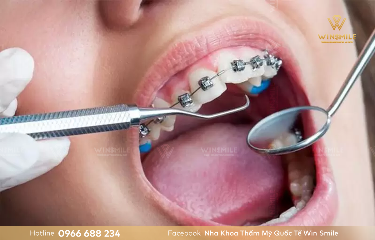 Niềng răng móm phải nhổ răng trong một số trường hợp phức tạp