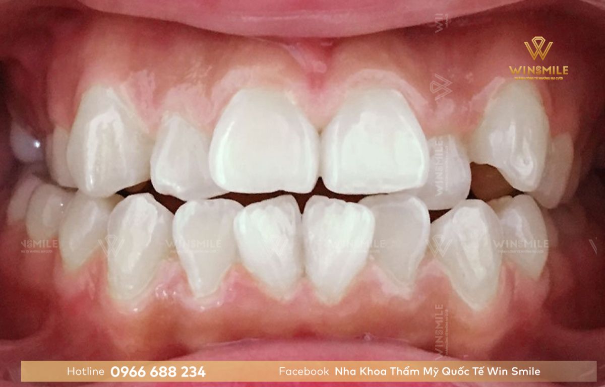 Tình trạng răng ảnh hưởng đến giá niềng răng mắc cài sứ
