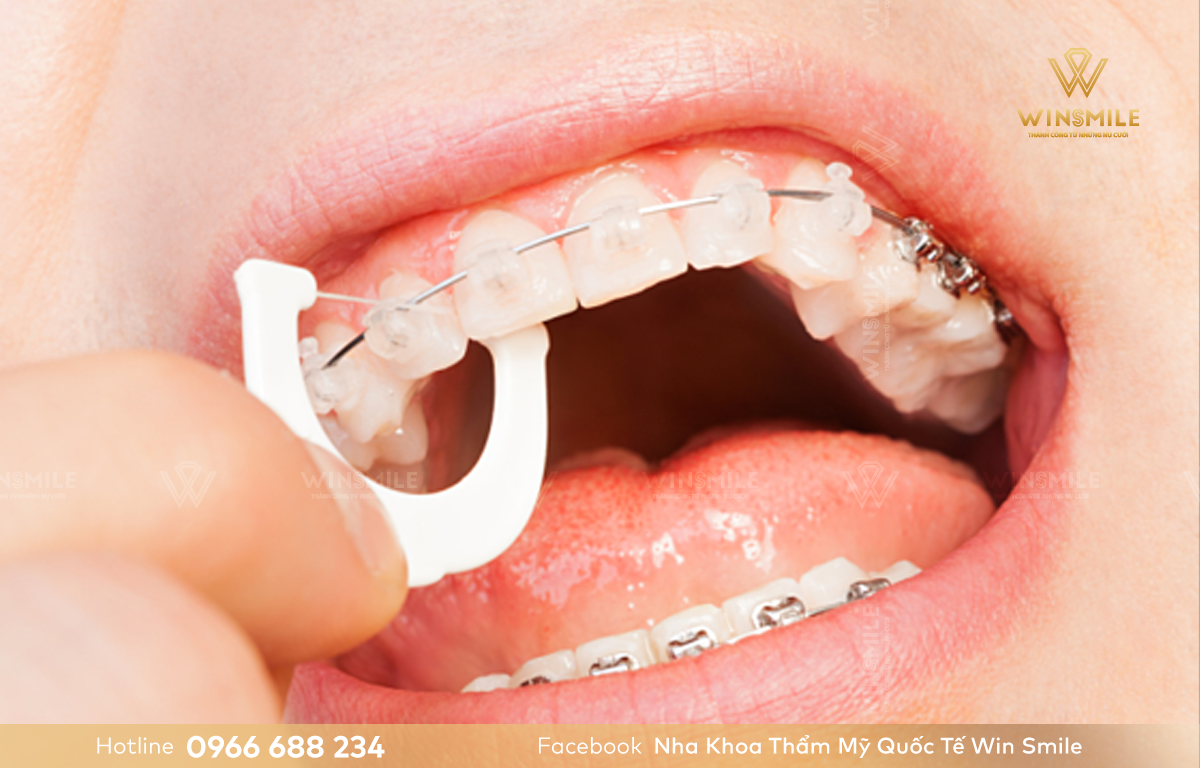 Tuân thủ chế độ vệ sinh đúng cách để tránh ố vàng răng niềng pha lê