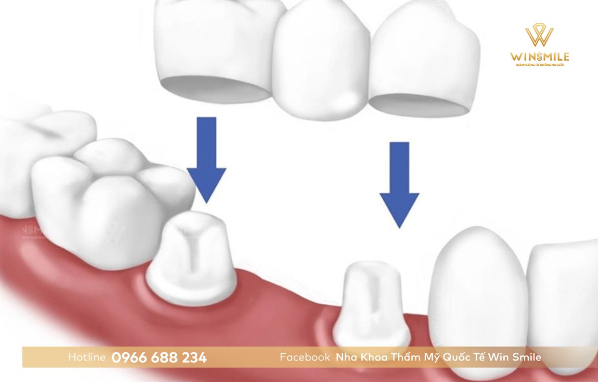 Mài 2 răng thật sau đó đặt cầu răng lên là cách hoạt động của cầu răng sứ