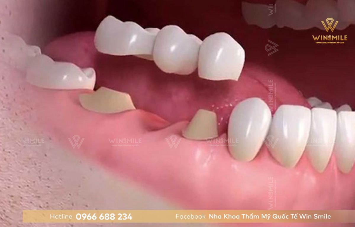 Trồng răng khi còn chân răng bằng cầu răng sứ