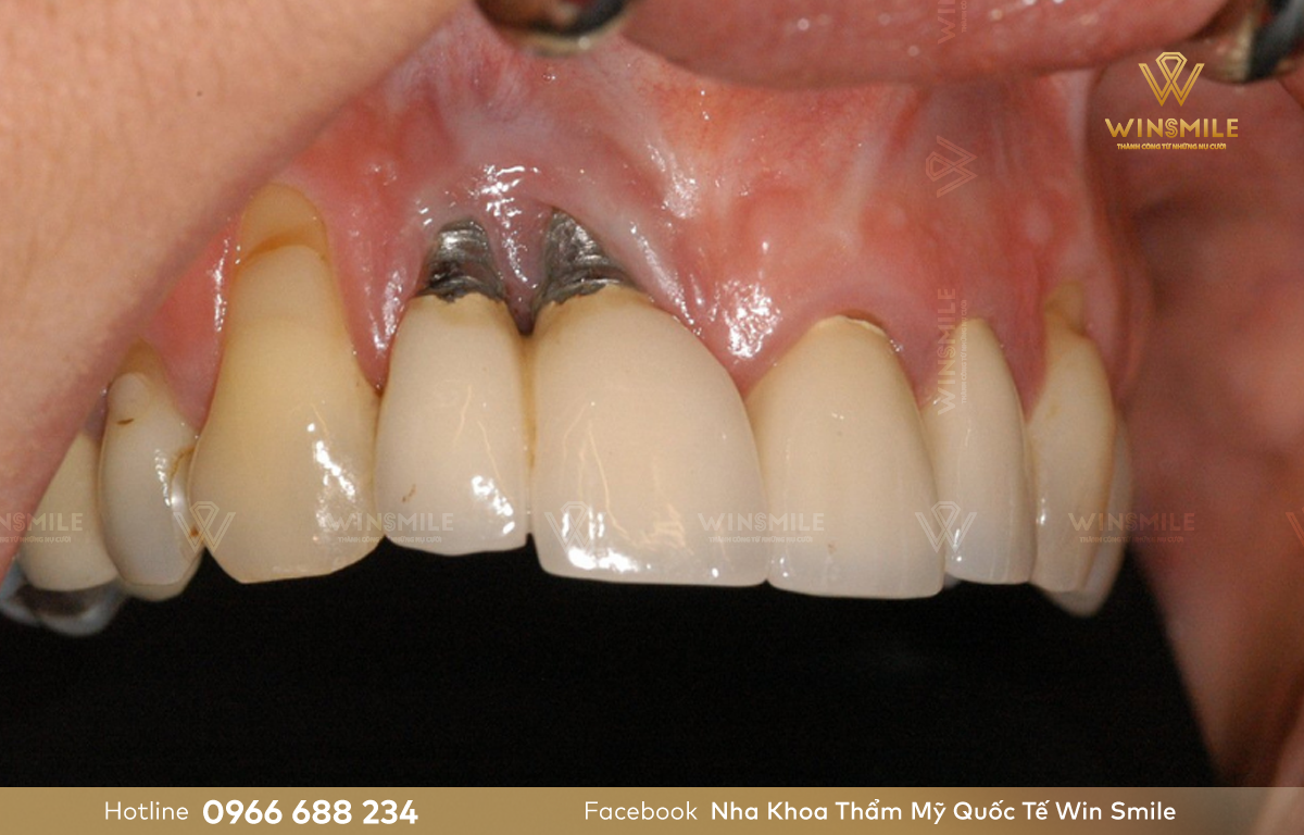 Trồng răng giá rẻ gây nhiều ảnh hưởng đến sức khỏe răng miệng và sức khỏe tổng quát