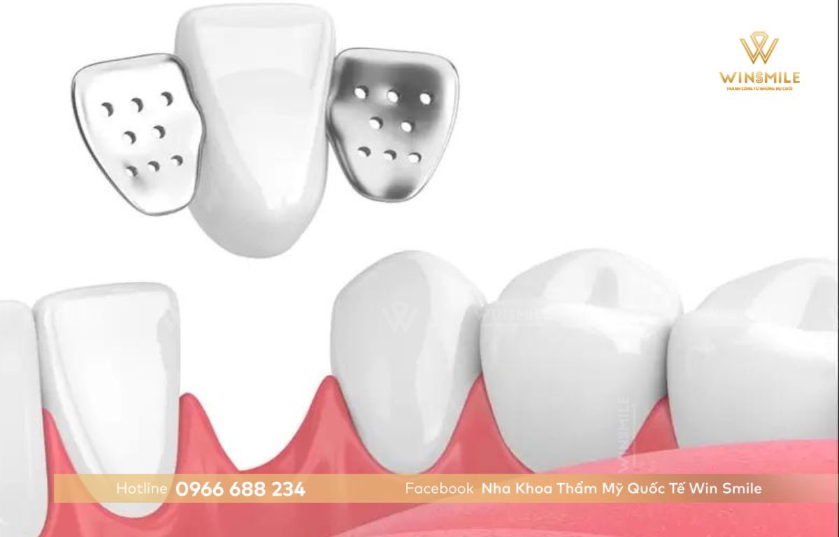 Có 4 loại cầu răng sứ phổ biến