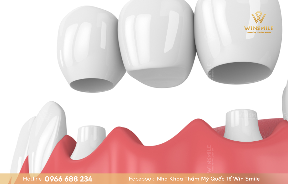 Cầu răng sứ áp dụng cho trường hợp răng bị sâu không thể giữ lại 