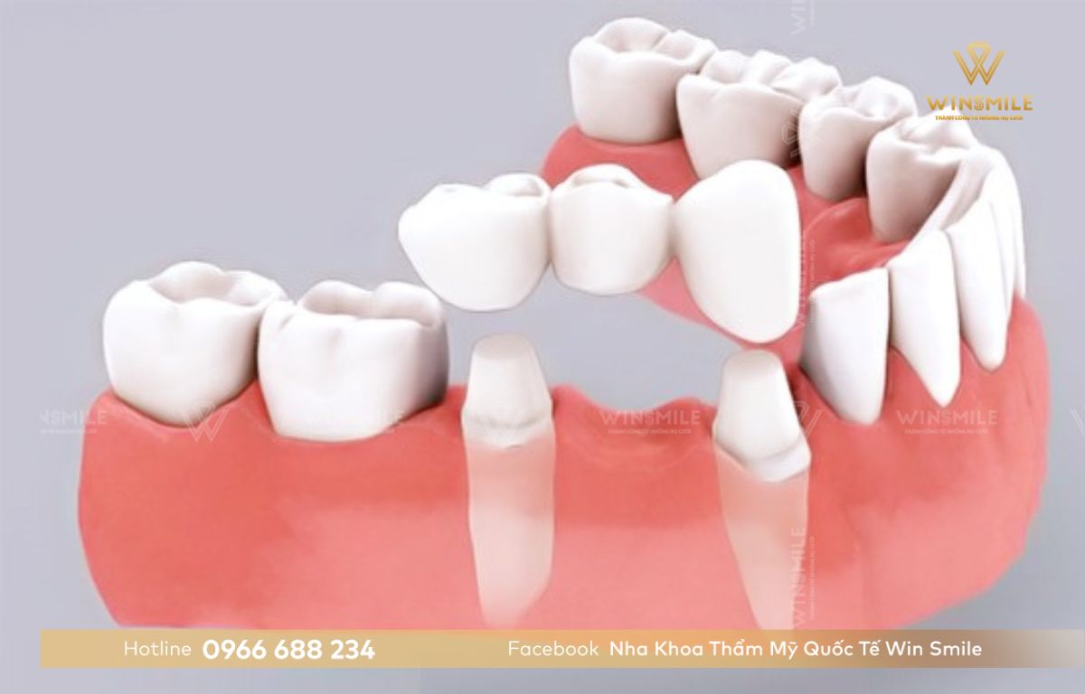 Trồng răng sứ bắc cầu thực hiện nhanh chóng, đảm bảo chức năng ăn nhai