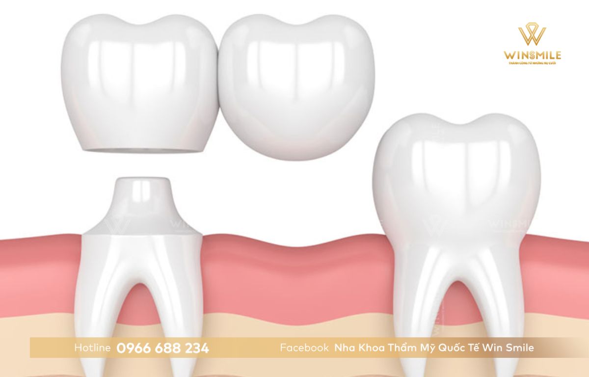 Câu răng sứ - Phương pháp phục hình răng mất hiệu quả