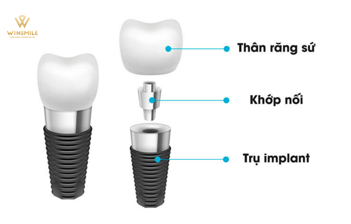 Răng Implant có cấu tạo gồm 3 phần: trụ Implant, Abutment và răng sứ.