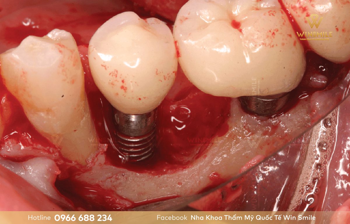 Chảy máu vùng cấy ghép là biến chứng thường gặp khi trồng răng Implant