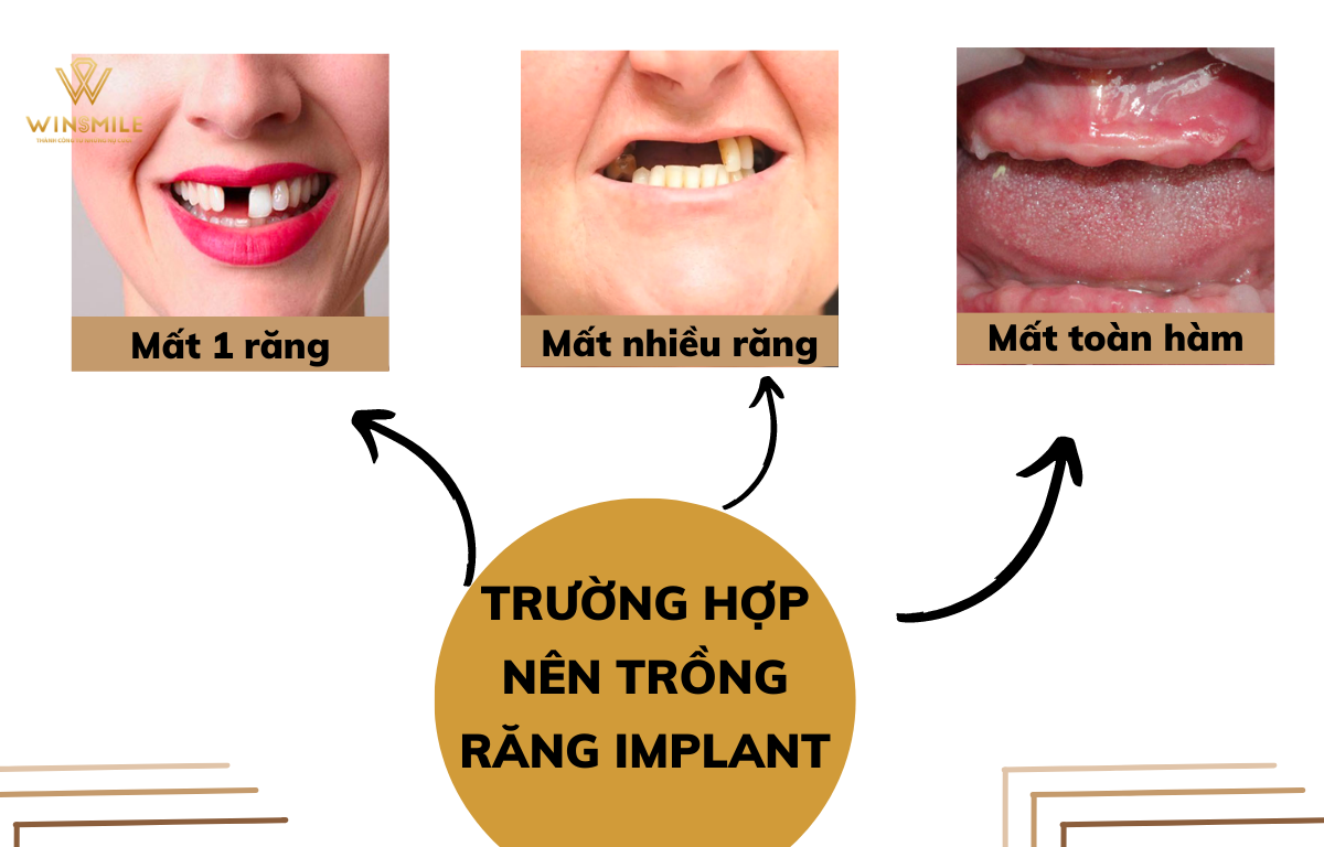  Cấy ghép Implant áp dụng cho mọi trường hợp mất răng.