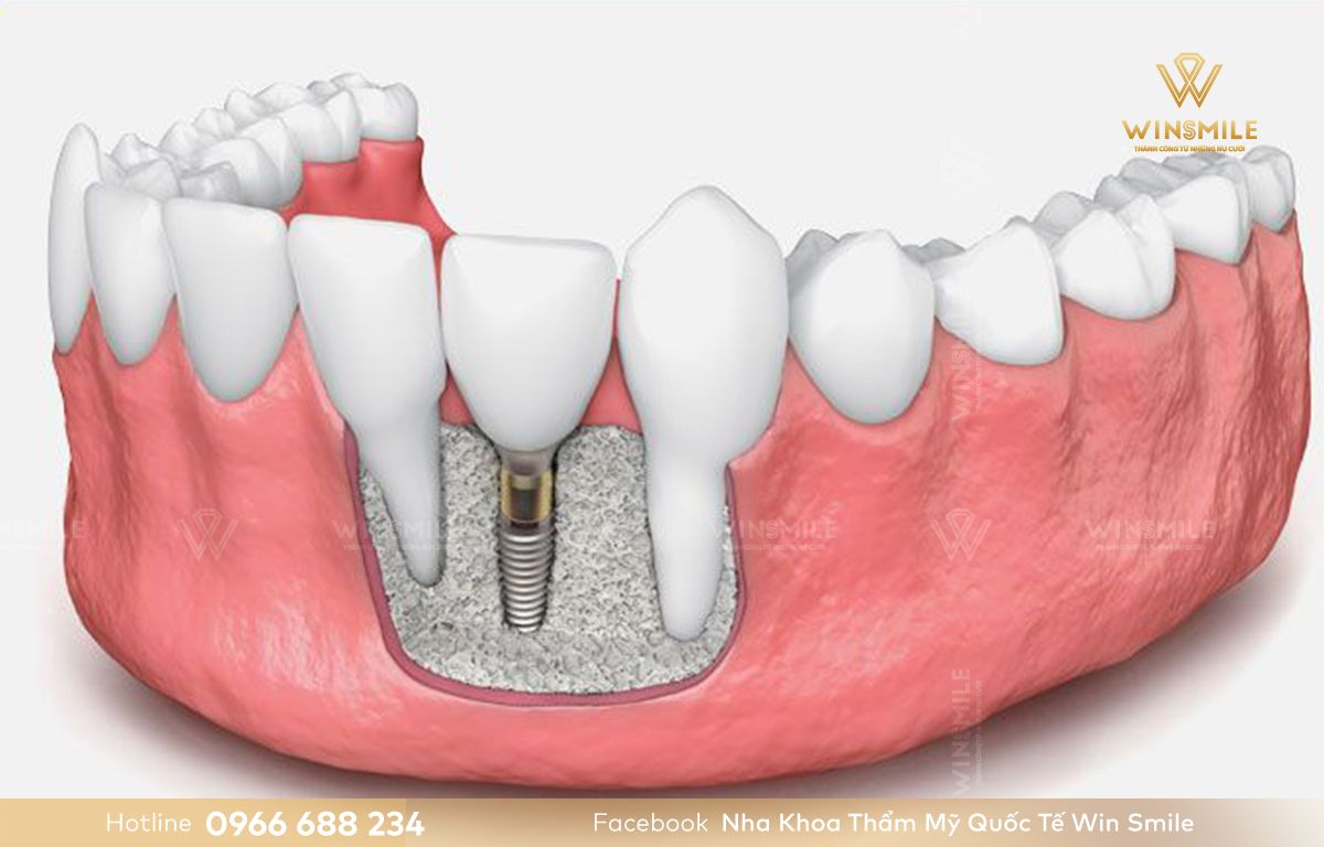Trụ Implant được đưa vào xương hàm thay thế chân răng mất.