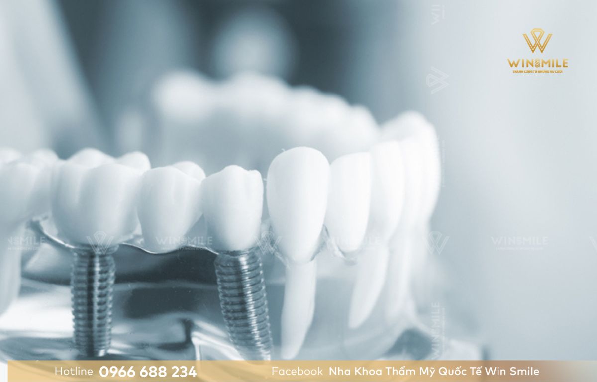 Trồng răng Implant được thực hiện bằng cách đưa trụ Implant vào xương hàm