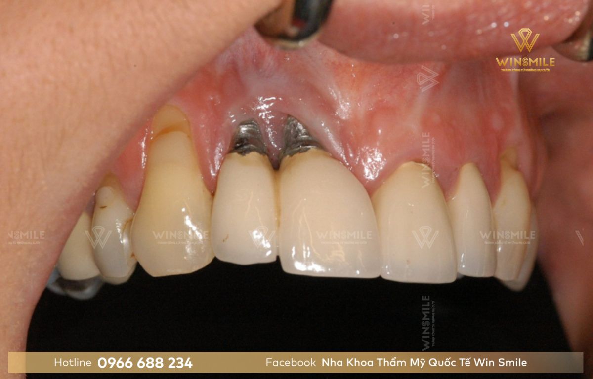 Răng implant sau khi lắp bị nhiễm trùng