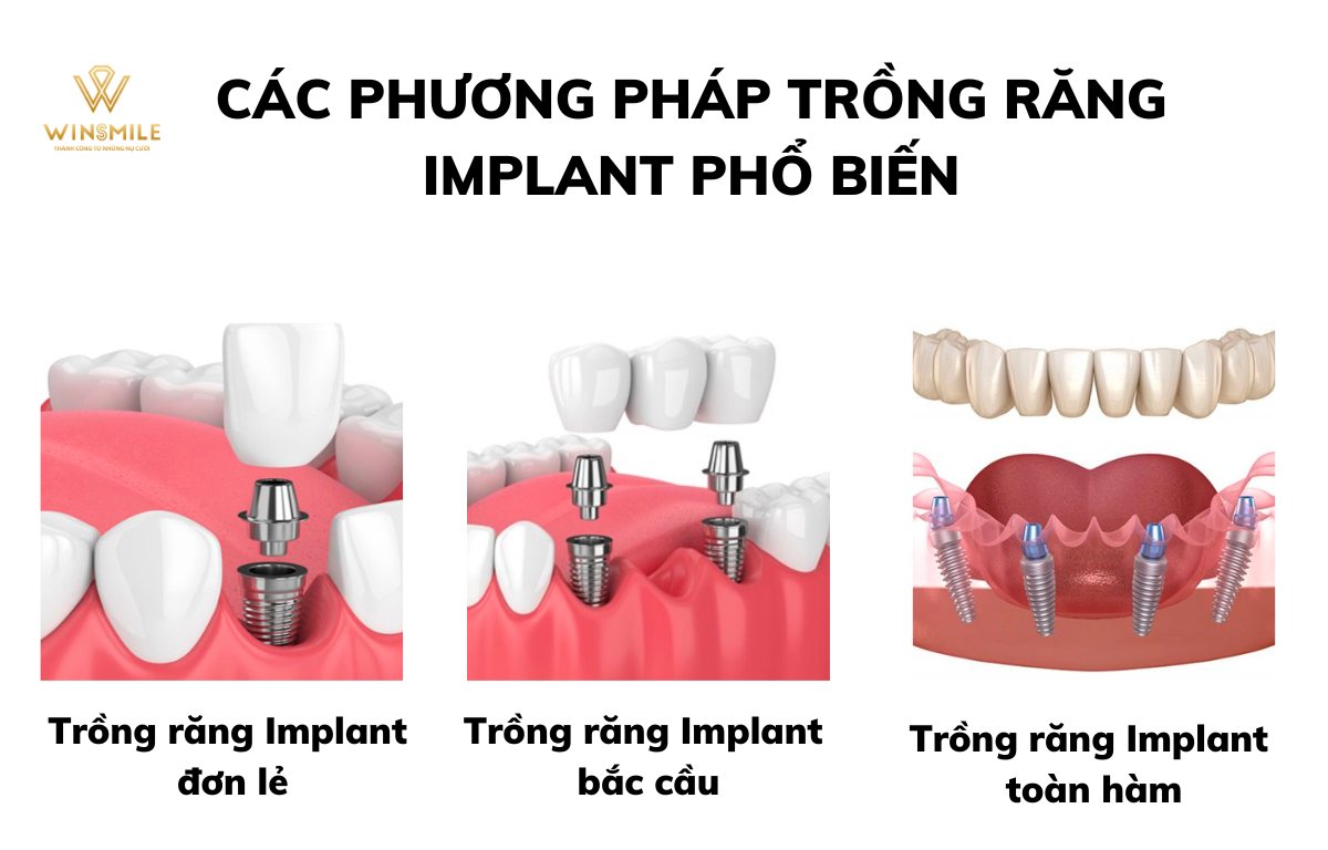 Có 3 phương pháp phục hình trồng răng Implant phổ biến