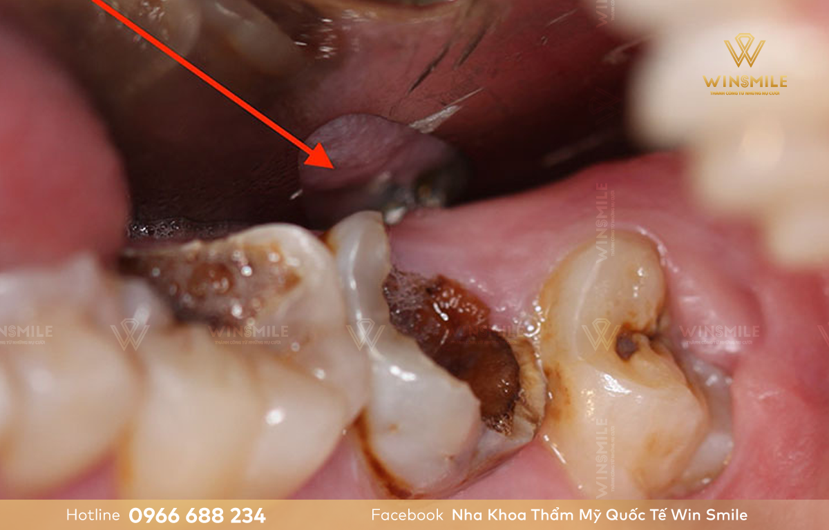 Răng chết tủy không thể khắc phục có thể trồng răng sứ