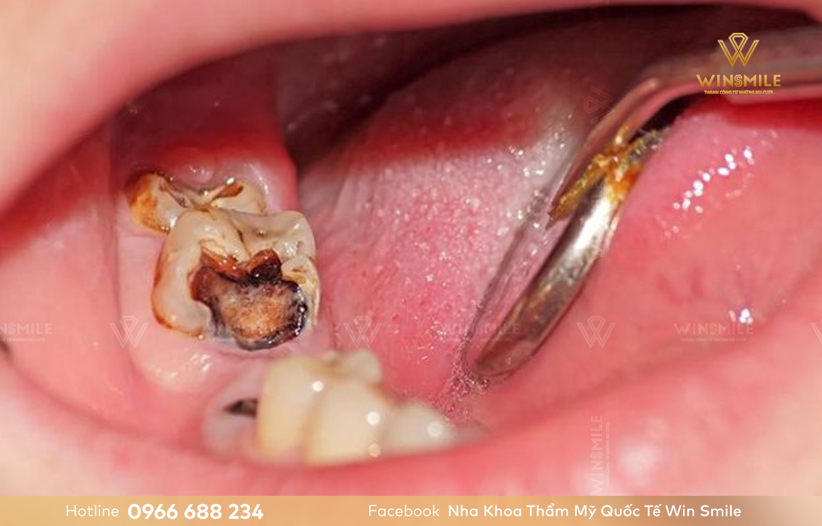 Răng hàm sâu cần nhổ khi đã ảnh hưởng đến tủy răng