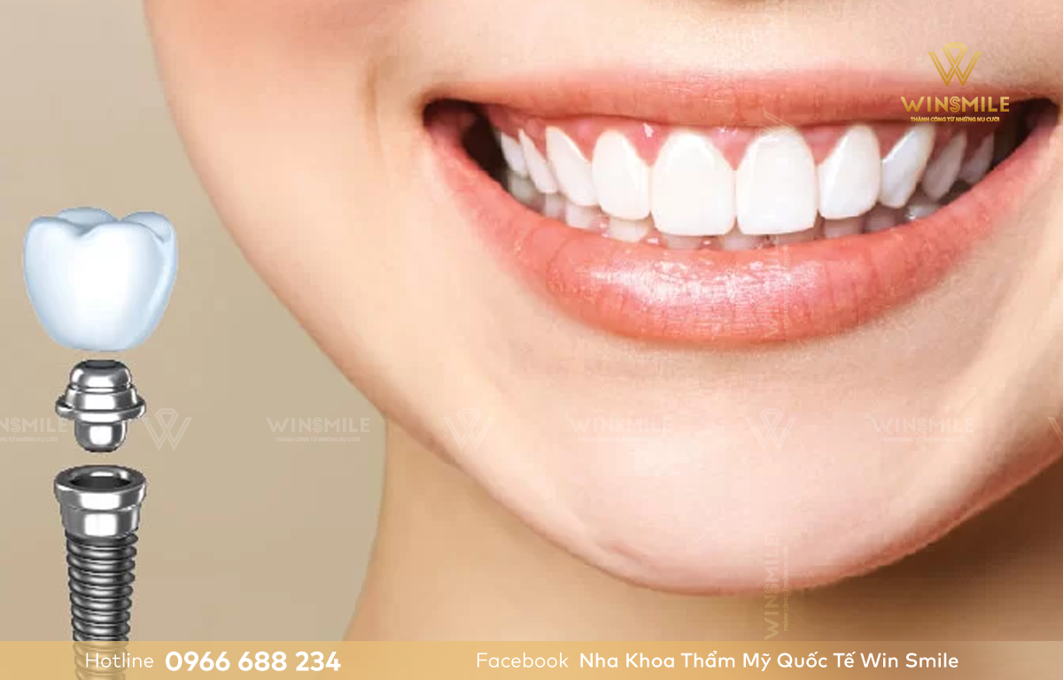 Răng Implant đảm bảo chức năng ăn nhai tốt và thẩm mỹ tối ưu