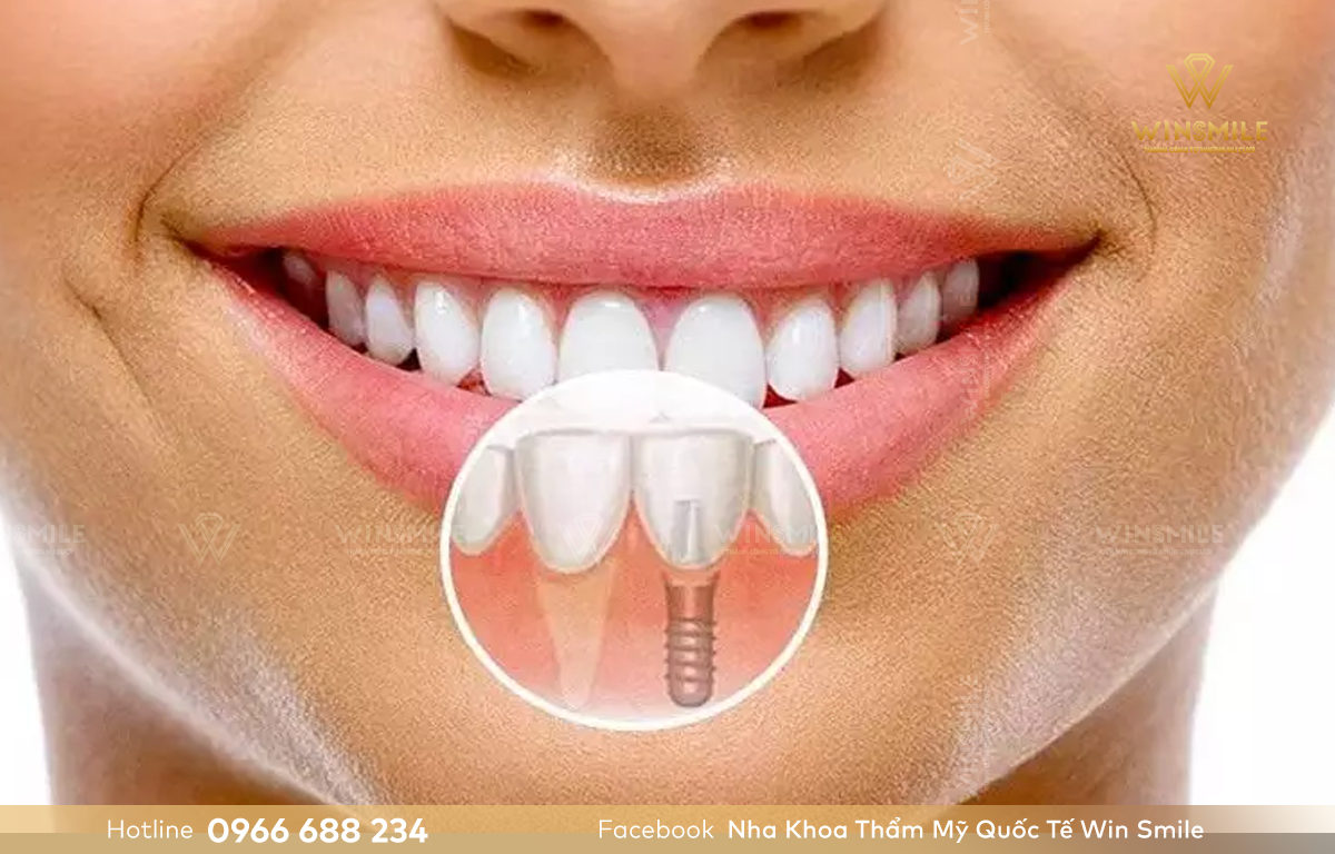 Răng Implant chắc chắn, ổn định như răng thật