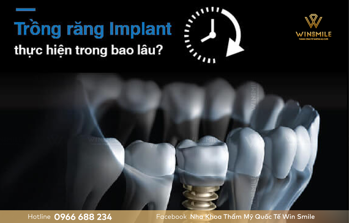 Thời gian trồng răng implant thông thường diễn ra khoảng 2-3 tháng