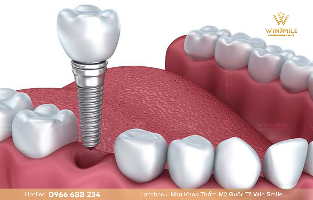 Trồng Implant răng hàm được đánh giá cao về mặt thẩm mỹ và chức năng 