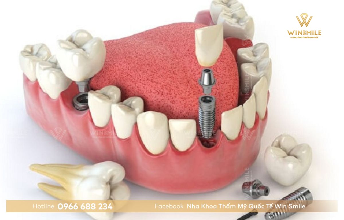 Trồng răng implant trả góp