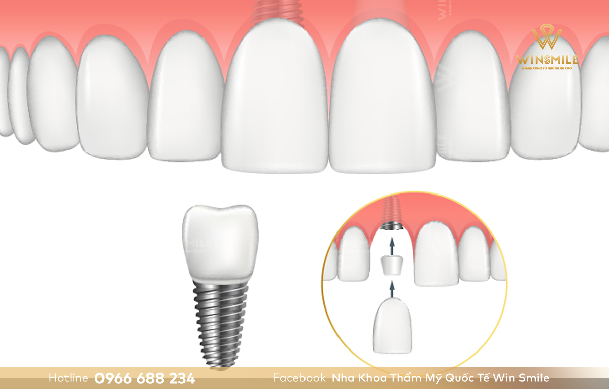 Phục hình răng bị sâu bằng cấy ghép Implant mang lại hiệu quả cao