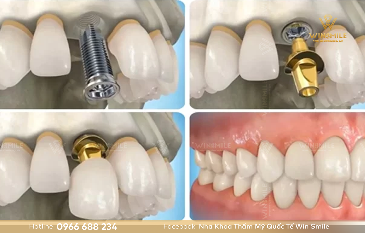 Trồng răng implant hàm trên cho hiệu quả lâu dài, ổn định 