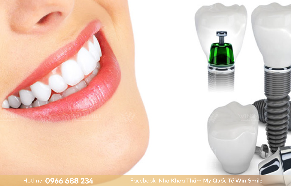 Trồng răng implant đảm bảo thẩm mỹ cao.